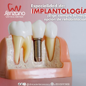 Implantes Dentales